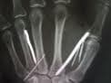 UPDATE: Maid could have nailed herself – Lankan physician
