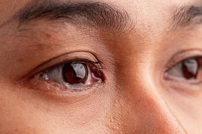 Health officials warn of rapidly spreading eye infection; public urged to follow health measures