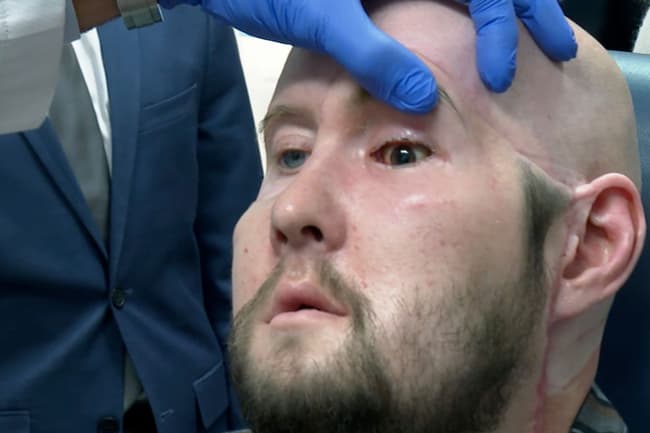 World’s first whole-eye transplant hailed as breakthrough 