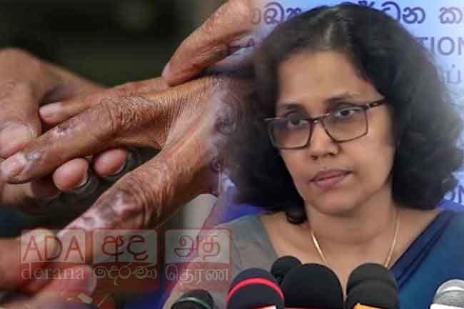 1,282 leprosy patients identified in Sri Lanka in 2025: Health officials