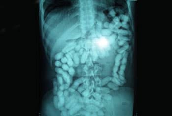 Gold recovered from Sri Lankan’s abdomen