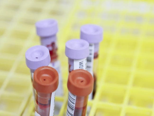 Another COVID-19 positive case hikes count to 171