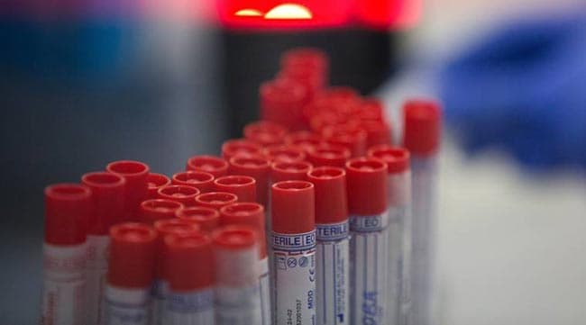COVID-19: 81 fresh cases jump total count to 1,453