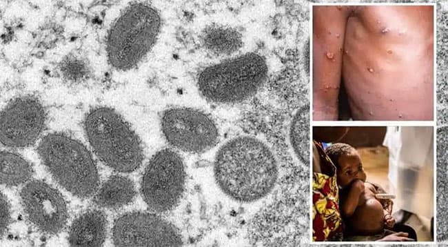 Dr. Jeewandara on Sri Lanka’s capacity to test and diagnose monkeypox