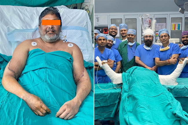 Indian painter gets donor hands in rare transplant surgery at Delhi hospital