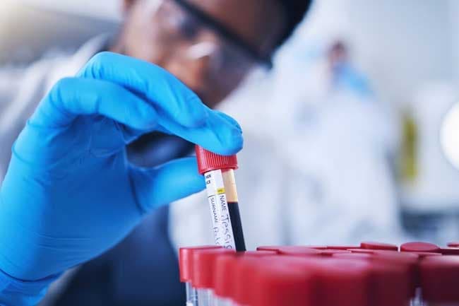 Blood test accurately diagnoses Alzheimer’s 90% of the time – study
