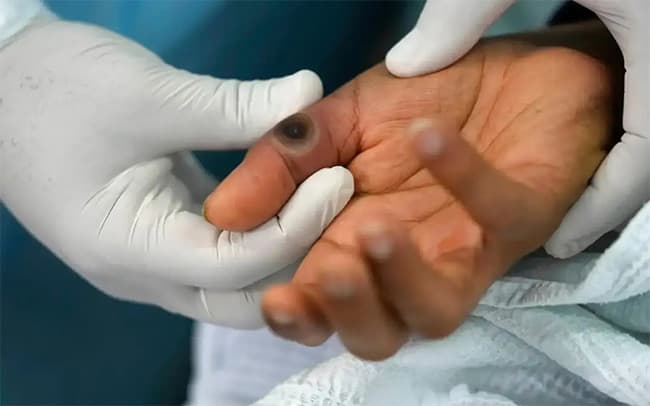 Philippines detects first mpox case this year, yet to determine strain