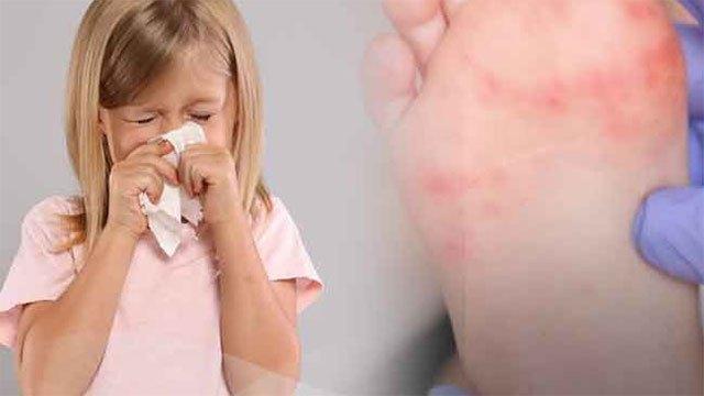 Several diseases spreading among children, parents urged to remain vigilant – Health Officials
