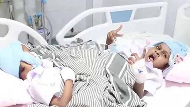 Sri Lankan medical team successfully separates conjoined twins after complex surgery